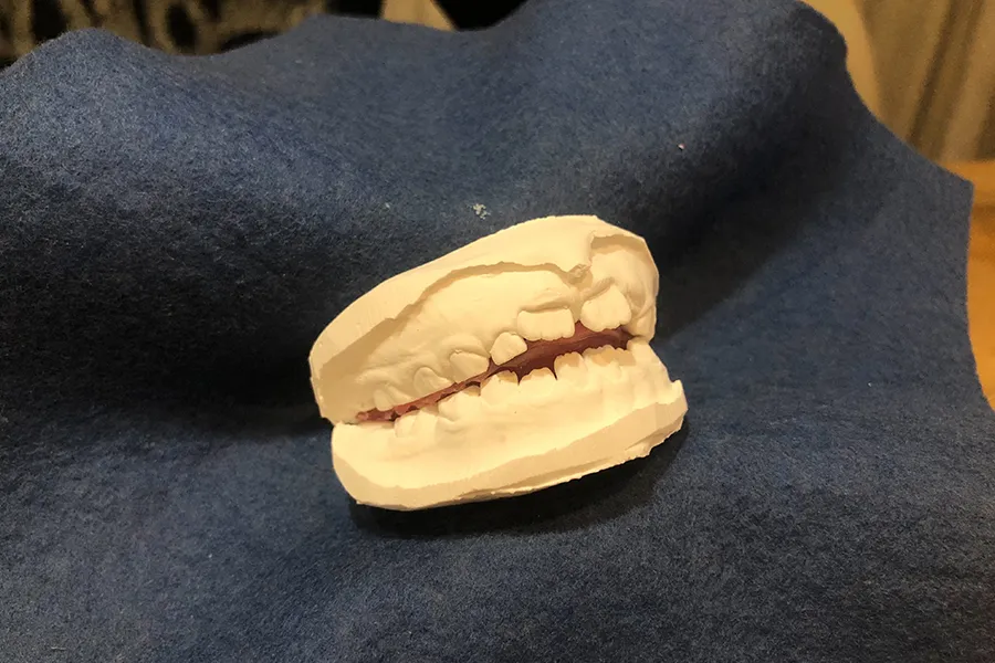 歯の型 